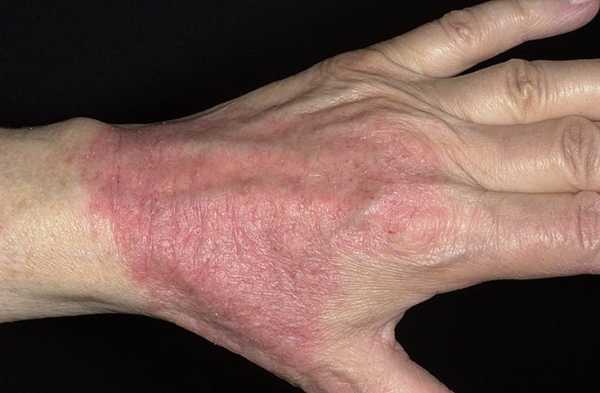 Причины аллергии на коже у детей